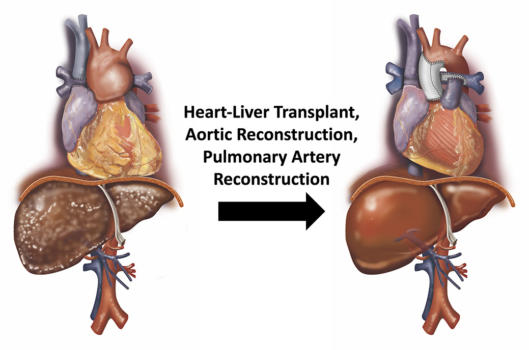 AATS Journals (@aatsjournals) on Twitter photo Reconstruction of the aorta and pulmonary artery during heart–liver transplantation in an adult congenital patient.
Read the full JTCVS Techniques article by Mullis, MacArthur, et al: doi.org/10.1016/j.xjtc…
#JTCVS <a href="/AATSHQ/">AATS</a> <a href="/tssmn/">CTSurgSocMedNetwork</a> <a href="/JW_MacArthur/">John W. MacArthur</a> Reconstruction of the aorta and pulmonary artery during heart–liver transplantation in an adult congenital patient.
Read the full JTCVS Techniques article by Mullis, MacArthur, et al: doi.org/10.1016/j.xjtc…
#JTCVS <a href="/AATSHQ/">AATS</a> <a href="/tssmn/">CTSurgSocMedNetwork</a> <a href="/JW_MacArthur/">John W. MacArthur</a>