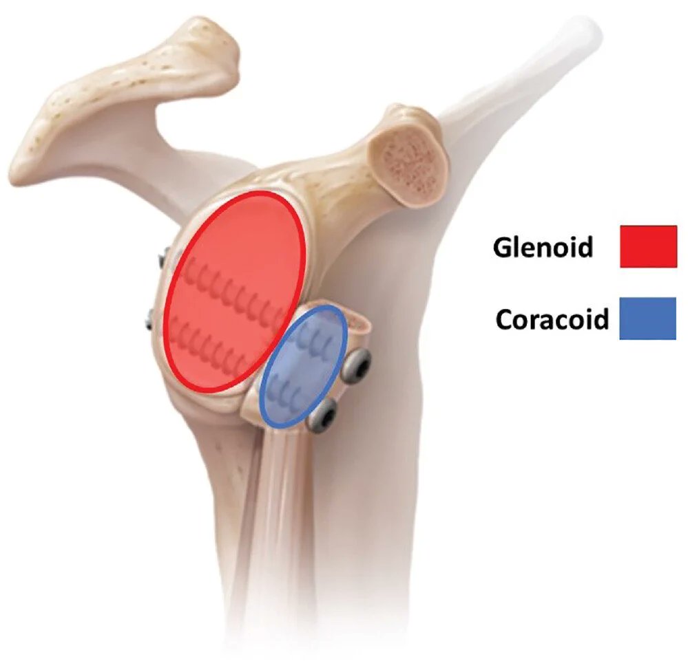 MoAImam's tweet photo. This study from @MOON_Shoulder
shows that the strongest predictor of bone loss in patients with anterior instability is the number of dislocations; with each subsequent dislocation, the risk for bone loss increases significantly.  #shoulderinstability https://t.co/75c9TYy4V6 https://t.co/itI4levRTX