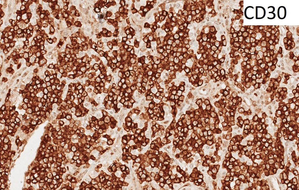 ALK+ anaplastic large-cell lymphoma expressing CD30 in a strong and uniform membranous and paranuclear (Golgi) pattern
#hemepath #hematology #PathTwitter #pathology <a href="/CCFPathRes/">Cleveland Clinic Pathology Residency</a> <a href="/evemariecrane/">Genevieve Crane, MD, PhD</a> <a href="/cebulka26/">Anna (Ania) B. Owczarczyk, MD PhD FASCP</a> <a href="/monakashim1/">Megan Nakashima</a> <a href="/alnoorakber/">Alnoor, MD النور اکبر</a> <a href="/Siddhar35280812/">Siddharth Bhattacharyya, MD</a> <a href="/DanBabuMD/">Daniel Babu, MD</a>