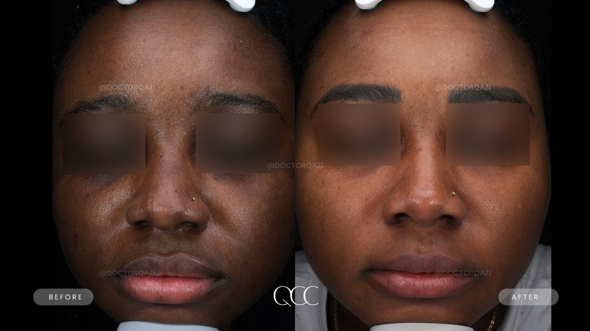 drnadirqazi's tweet image. Melasma Transformation ⬇️

For a consultation, please call/text 949-336-7293

qaziclinic.com/treatments/hyp…

#co2laser #laser #lasertreatment #lasertreatments #laserskinresurfacing #melasma #melasmatreatment #melasmabeforeandafter #laserskincare #laserskinrejuvenation #orangecounty