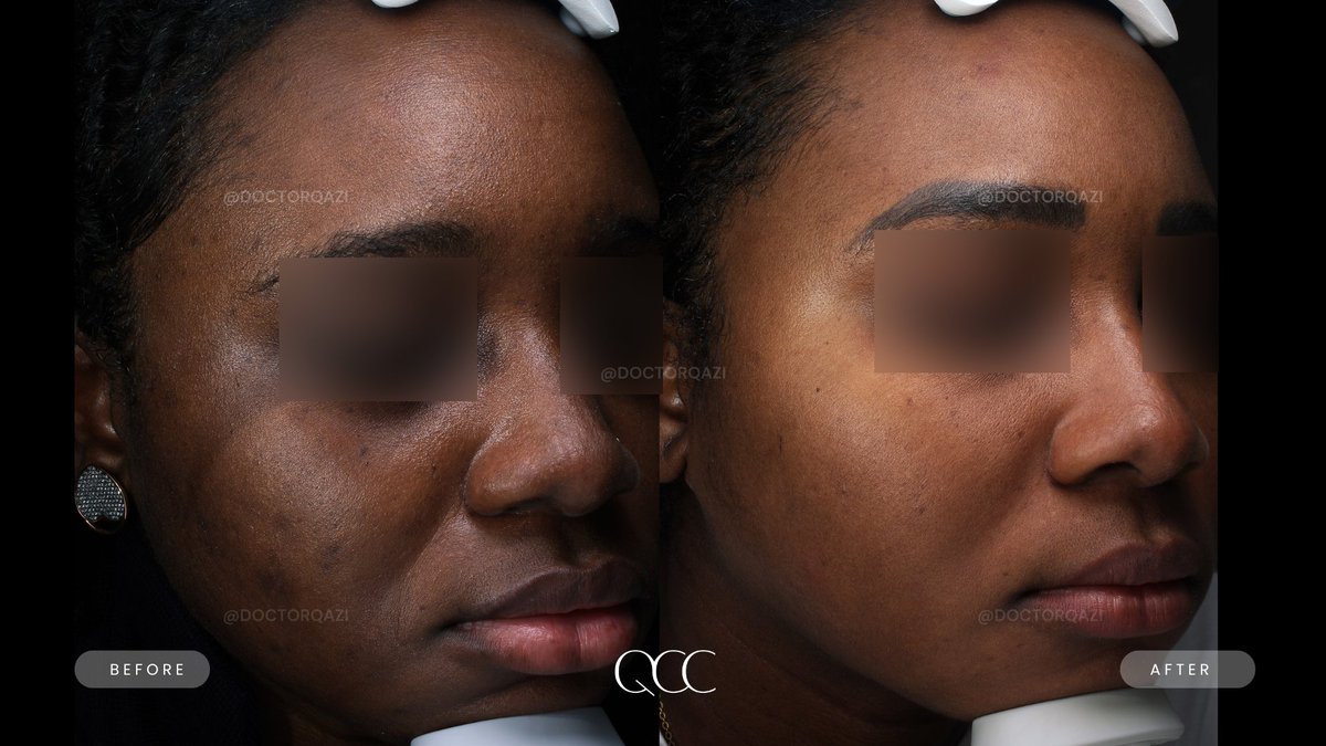 drnadirqazi's tweet image. Melasma Transformation ⬇️

For a consultation, please call/text 949-336-7293

qaziclinic.com/treatments/hyp…

#co2laser #laser #lasertreatment #lasertreatments #laserskinresurfacing #melasma #melasmatreatment #melasmabeforeandafter #laserskincare #laserskinrejuvenation #orangecounty