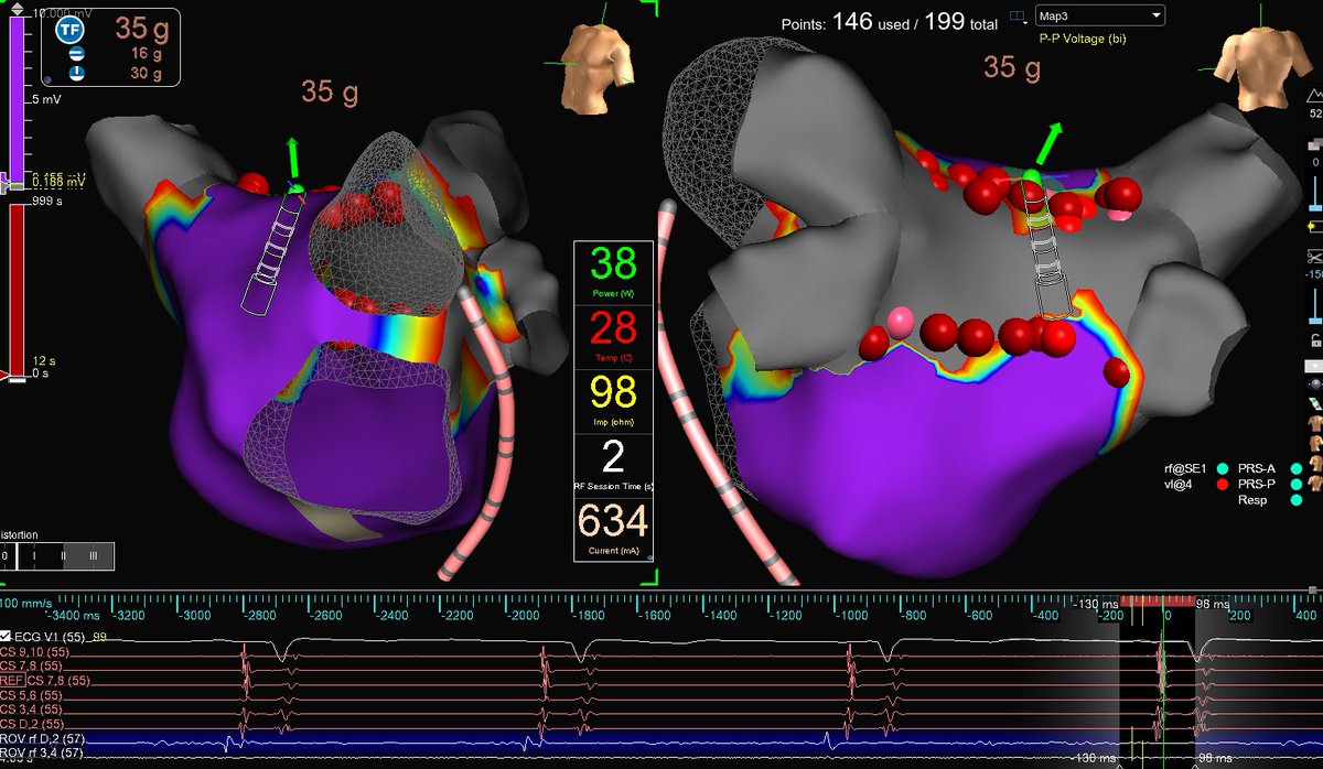 martinezcarl3D's tweet photo. Great to see fast signal reduction with #Tactiflex to complete PWI.

@dkenigsberg @AbbottCardio https://t.co/qHDswDtBSO