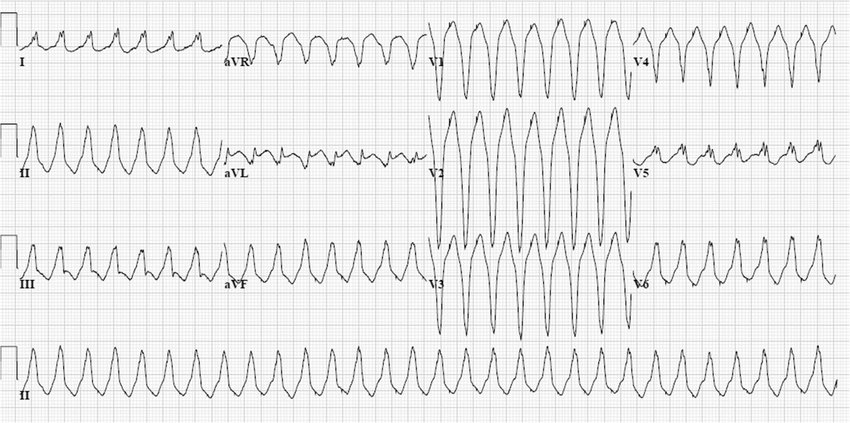 walinjom's tweet photo. Do NOT use Verapamil in Ventricular tachycardia. https://t.co/cnwPNKov5N