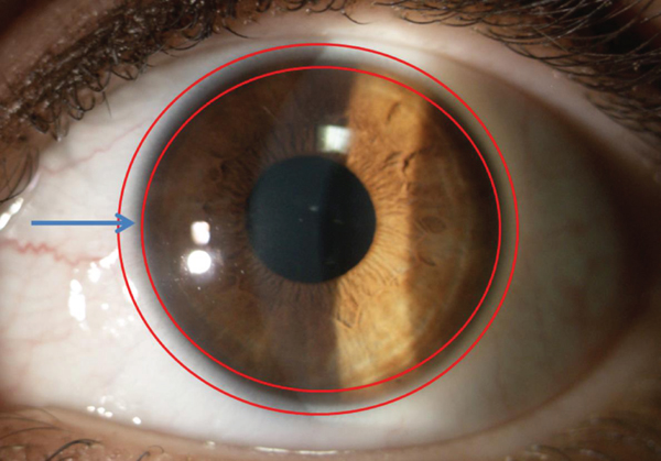 3syncR's tweet photo. Clinical trials are underway for a new treatment called cultivated autologous limbal epithelial cell transplantation. This procedure takes healthy stem cells from the patient's other eye, grows them in a lab, and then transplants them into the damaged eye.
https://t.co/RUy0nUNUE8 https://t.co/zZdawYpo9A