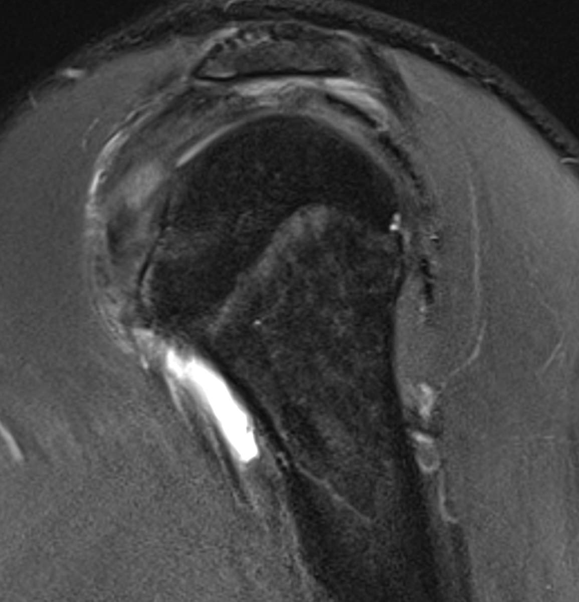 🎯What are the main findings here? 
🎯What has subluxed?
🎯Which pulley has been injured?

#mskrad #radres #radfellow