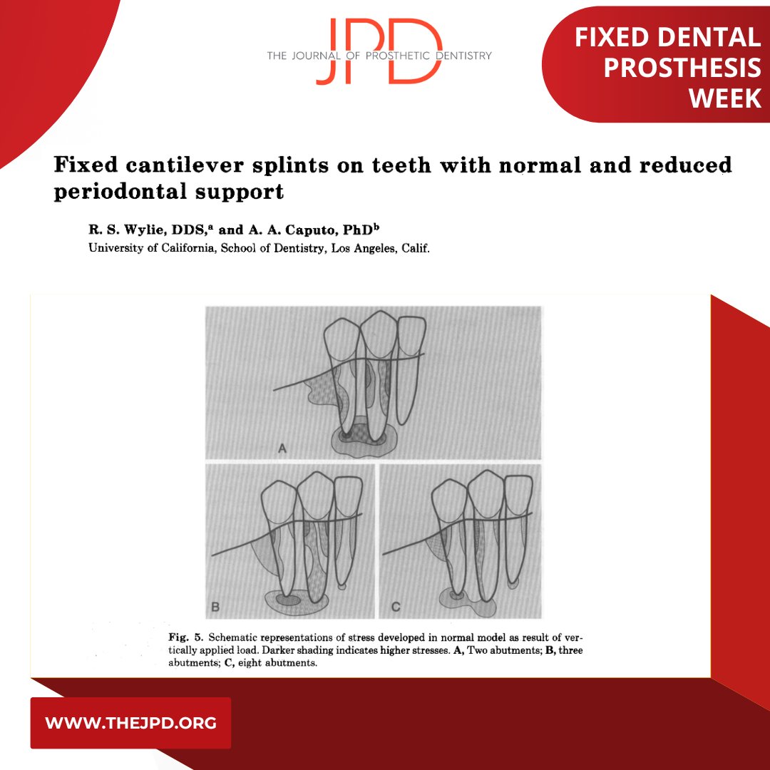 JPDentistry's tweet photo. This week on #theJPD, we learn about #fixeddentalprosthesis.

This study examines the stress distribution when splinting a varying combination of #abutment #teeth with &amp; without #periodontal bone loss to support a #tooth supported #fixeddentalprosthesis: https://t.co/ce4HSL5VMf https://t.co/aAXQtazc0q