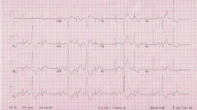 What do you see? best explanation? #EPeeps #EPfellows #CardioTwitter