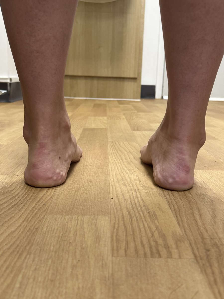 DrJN_SportsMed's tweet photo. Consent ✅ Interesting F&A case! 🦶👣

F 40s, increasing mid & rear foot pain on starting HIIT training - 10 year history low level ache & describing foot 'wonky' & unstable on uneven terrain

Observation - rear foot varus alignment R side vs L neutral

Stiff, painful mid foot & subtalar joint on pronation / supination

Weight bearing X-rays - talonavicular joint osteoarthritis & rear foot varus

MRI - Mueller-Weiss syndrome - lateral navicular collapse (? secondary to osteonecrosis) leading to pseudo-deformity of rear foot, TNJ OA & effusion, & now secondary subtalar joint degenerative changes

For CT to evaluate further - will need MDT approach -  podiatry / biomechanical input, ortho review, inject TNJ for short-medium term pain management