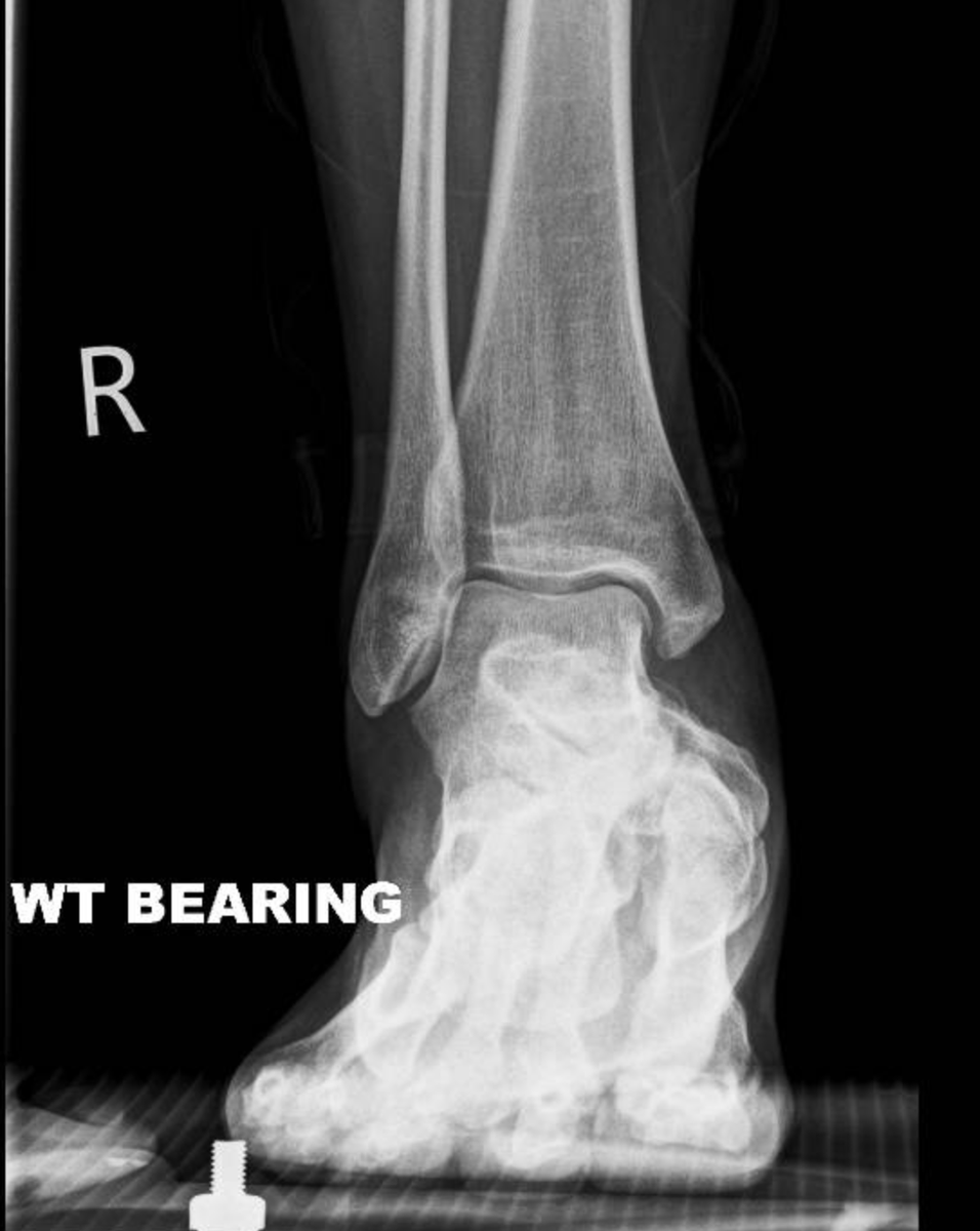 DrJN_SportsMed's tweet photo. Consent ✅ Interesting F&A case! 🦶👣

F 40s, increasing mid & rear foot pain on starting HIIT training - 10 year history low level ache & describing foot 'wonky' & unstable on uneven terrain

Observation - rear foot varus alignment R side vs L neutral

Stiff, painful mid foot & subtalar joint on pronation / supination

Weight bearing X-rays - talonavicular joint osteoarthritis & rear foot varus

MRI - Mueller-Weiss syndrome - lateral navicular collapse (? secondary to osteonecrosis) leading to pseudo-deformity of rear foot, TNJ OA & effusion, & now secondary subtalar joint degenerative changes

For CT to evaluate further - will need MDT approach -  podiatry / biomechanical input, ortho review, inject TNJ for short-medium term pain management