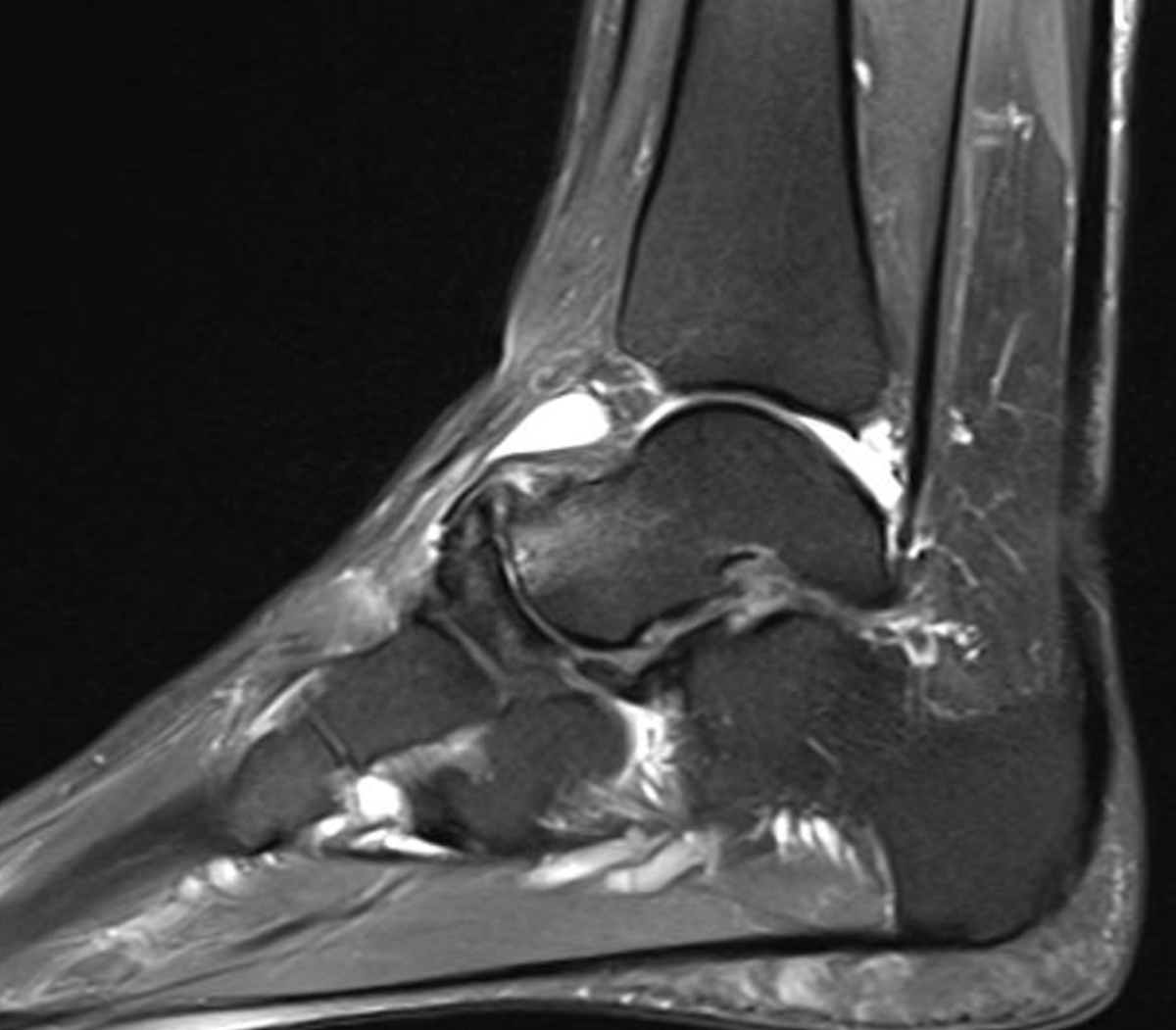 DrJN_SportsMed's tweet photo. Consent ✅ Interesting F&A case! 🦶👣

F 40s, increasing mid & rear foot pain on starting HIIT training - 10 year history low level ache & describing foot 'wonky' & unstable on uneven terrain

Observation - rear foot varus alignment R side vs L neutral

Stiff, painful mid foot & subtalar joint on pronation / supination

Weight bearing X-rays - talonavicular joint osteoarthritis & rear foot varus

MRI - Mueller-Weiss syndrome - lateral navicular collapse (? secondary to osteonecrosis) leading to pseudo-deformity of rear foot, TNJ OA & effusion, & now secondary subtalar joint degenerative changes

For CT to evaluate further - will need MDT approach -  podiatry / biomechanical input, ortho review, inject TNJ for short-medium term pain management