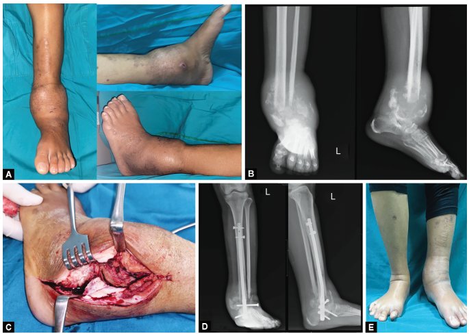 JaypeeJournals's tweet photo. #Limb Salvage for #CharcotNeuroarthropathy of the #AnkleJoint: A Case Series https://t.co/seCSpGYAEd
#RadenAndriPrimadhi #JFASAP #JaypeeJournals https://t.co/vKCDLHyYfu