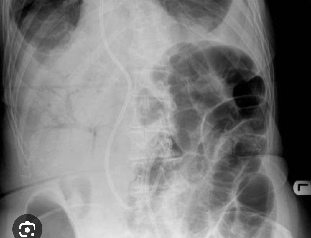 Shubhra_011's tweet photo. Preterm,birth weight 1 kg, admitted in NICU,
developed distension of abdomen,
altered aspirates on day of life 8.
♦️ What is your diagnosis?
♦️What does the Xray abdomen below show ?
♦️Name of the staging and what stage does the below image show?
#neonatology
#cloherty https://t.co/aeo2VNB6gS