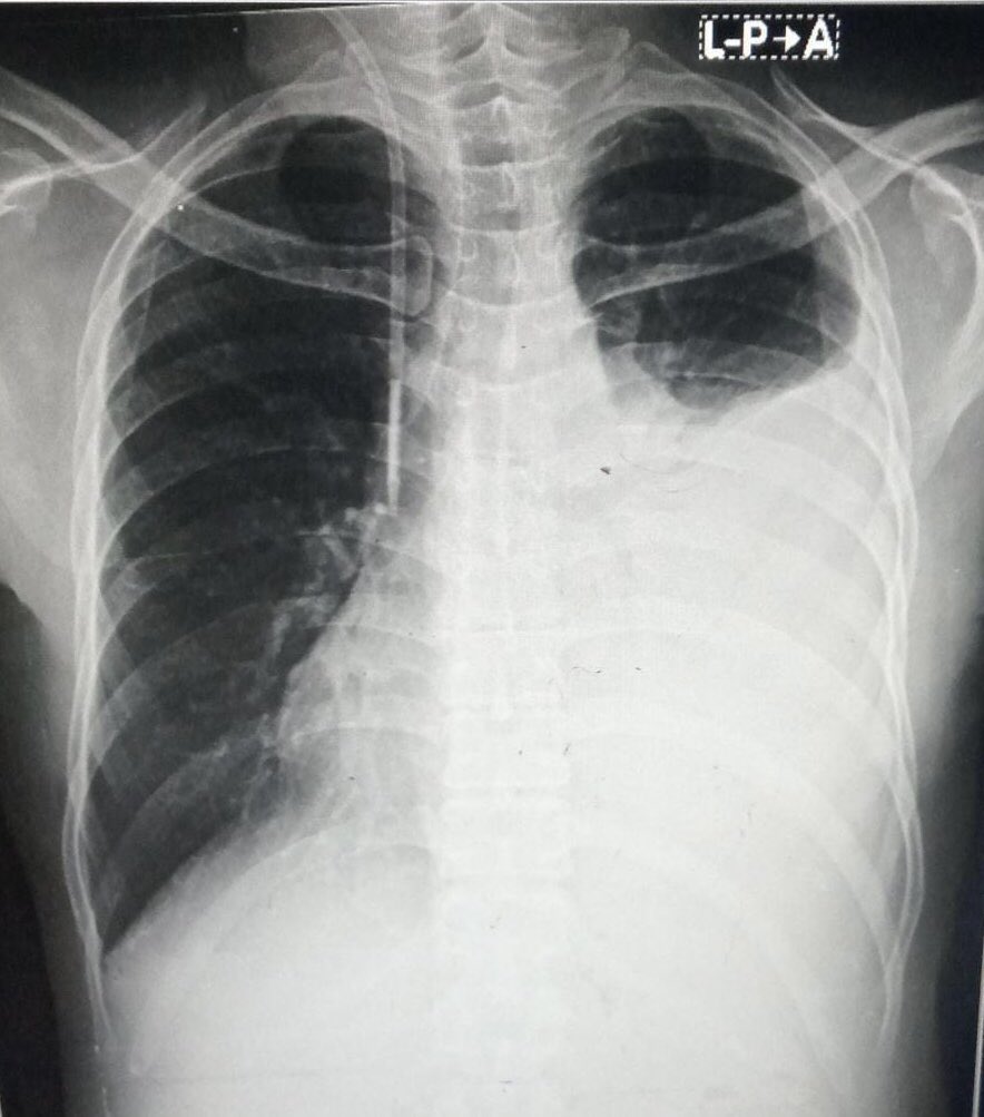 Lets do X-rays this week! 
What do you see here? 
#MedicalGlobe #MG #MedTwitter