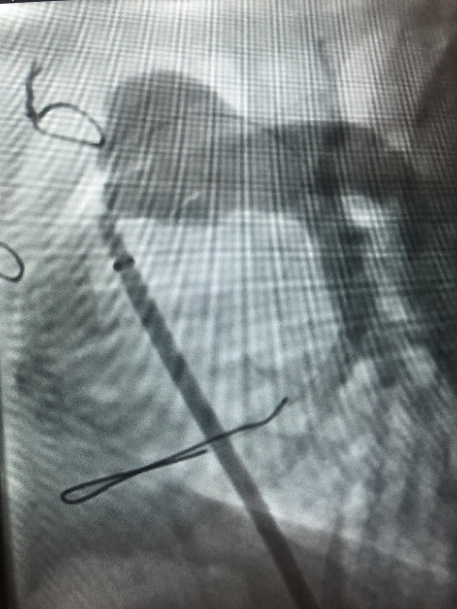 Rblancomata's tweet photo. Vuelta de vacaciones y para abrir boca! 50d, 3,5kg, TF con hemocorrección, estenosis  infundibular severa, crisis hipoxicas……implante de stent 7x19, post-dilatac con 10x20, paliativo hasta corrección Q.…@luisfergon82 @Juancar_Astorga @Aidaacinla @koldobikags @hemodinamicacr1 https://t.co/kQ4wiH0Xew
