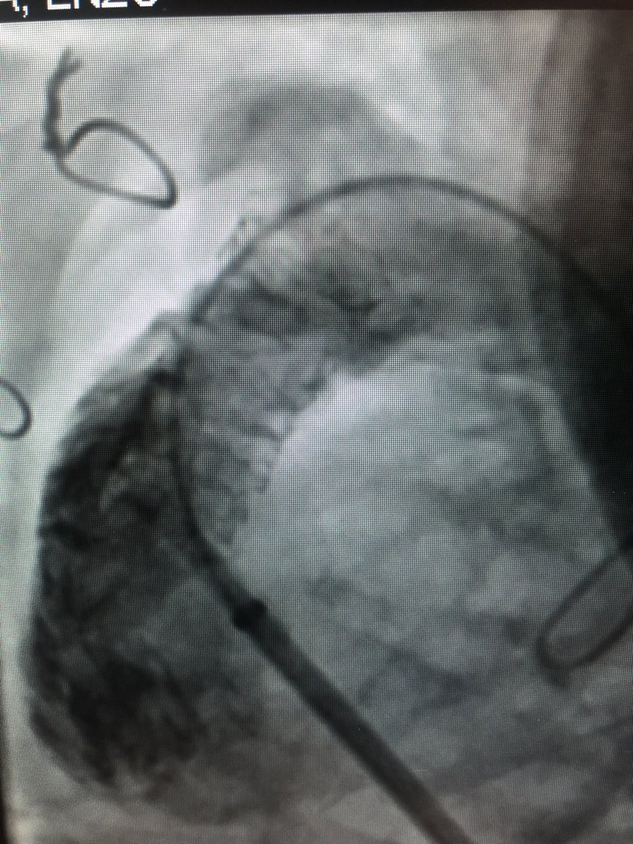 Rblancomata's tweet photo. Vuelta de vacaciones y para abrir boca! 50d, 3,5kg, TF con hemocorrección, estenosis  infundibular severa, crisis hipoxicas……implante de stent 7x19, post-dilatac con 10x20, paliativo hasta corrección Q.…@luisfergon82 @Juancar_Astorga @Aidaacinla @koldobikags @hemodinamicacr1 https://t.co/kQ4wiH0Xew