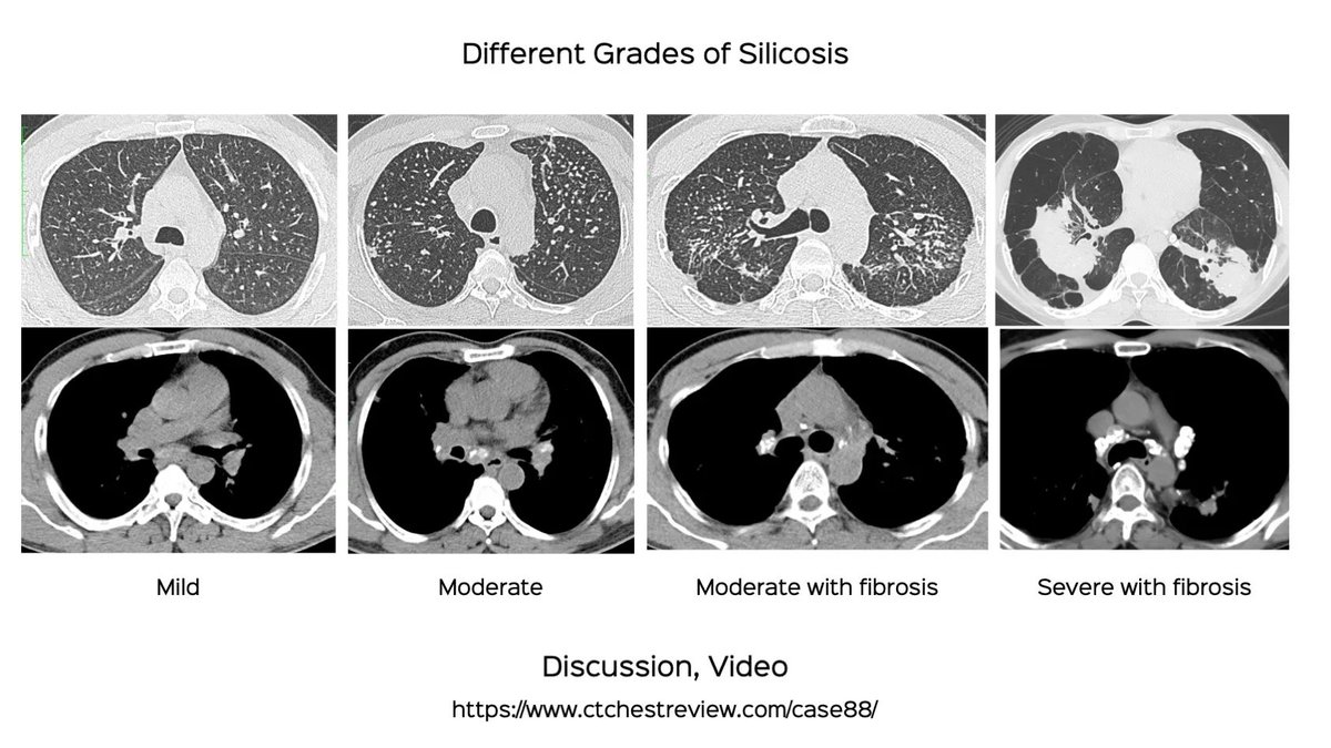 The Grades of Silicosis on CT Scan

Discussion video
ctchestreview.com/case88/

#chestrad #ctchest #FOAMrad #radres #ILDs #flourmill #silicosis