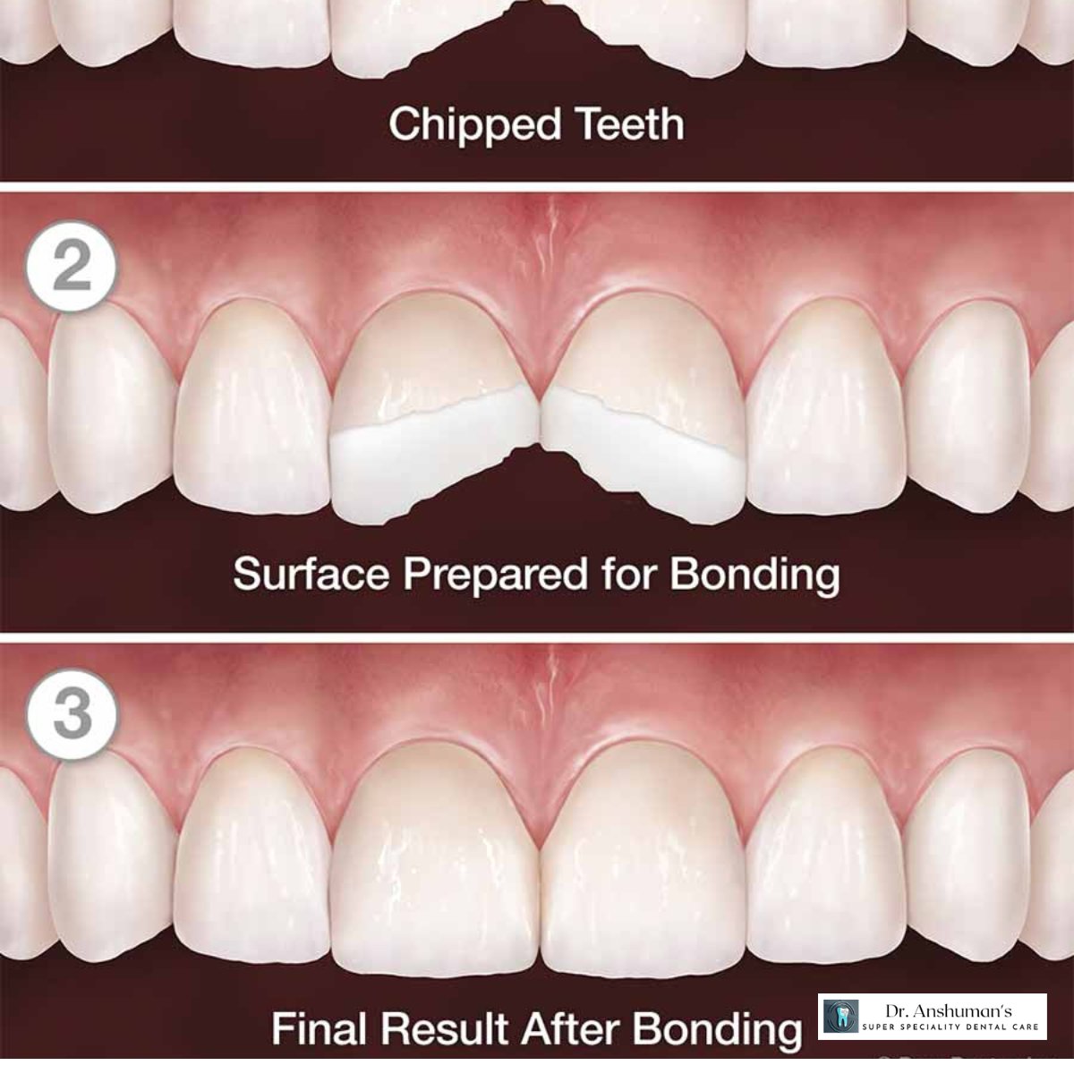 AnshumanSuper's tweet photo. Causes of chipped teeth
Teeth can chip for any number of reasons. Common causes include:
1. biting down on hard substances, like ice or hard candy
2. falls or car accidents
3. playing contact sports without a mouth guard
4. grinding your teeth when you sleep
#chippedtooth https://t.co/Js5FtBw2Wg