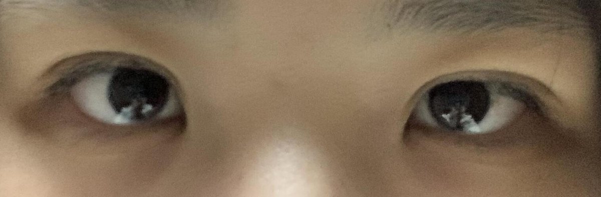 futaediary's tweet photo. もももさん(20)の埋没正直レポ👀

🏥クリニック：湘南美容外科恵比寿院
👨‍⚕️執刀医：新里龍策先生
✏️メニュー名：フォーエバー二重術　永久保証　笑気麻酔、局所麻酔
💰料金：180,000円

ダウンタイム★★★★☆
ダウンタイム2日目↓
....
ダウンタイム3日目↓
....痛みはあまりなく、3日目から化粧も可能なため春休みだったこともあり、特に不自由なく過ごせた。目元の内出血は気づかれるかも。

カウンセリング★★☆☆☆
アドバイザー的なスタッフがひたすらプレゼンしてくる感じで、執刀医とあまり話す時間はなかった。高いプランをすすめられる。
before↓
....
執刀医の技術★★★☆☆
態度・対応★★★☆☆
淡々としていたが、優しかった。施術中も笑気麻酔で意識が朦朧としていたが、順調だよなどと声はかけてくれた。
after↓
....
みんなにアドバイス！:
色んなところをカウンセリング回った方が絶対にいいと思います。

さらに詳しいレポはプロフリンクから✨
クリニックや執刀医ごとにレポを探せます📝
悪い口コミ、瞬きをしている動画も公開しています◎