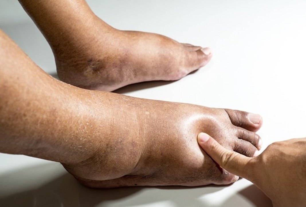 DrOribaDan's tweet photo. No body ever died of peripheral edema, it took a while for it to accumulate, and it takes a while for it to dissappear. Do not try to make it go away too fast. https://t.co/66aNd0jwyo