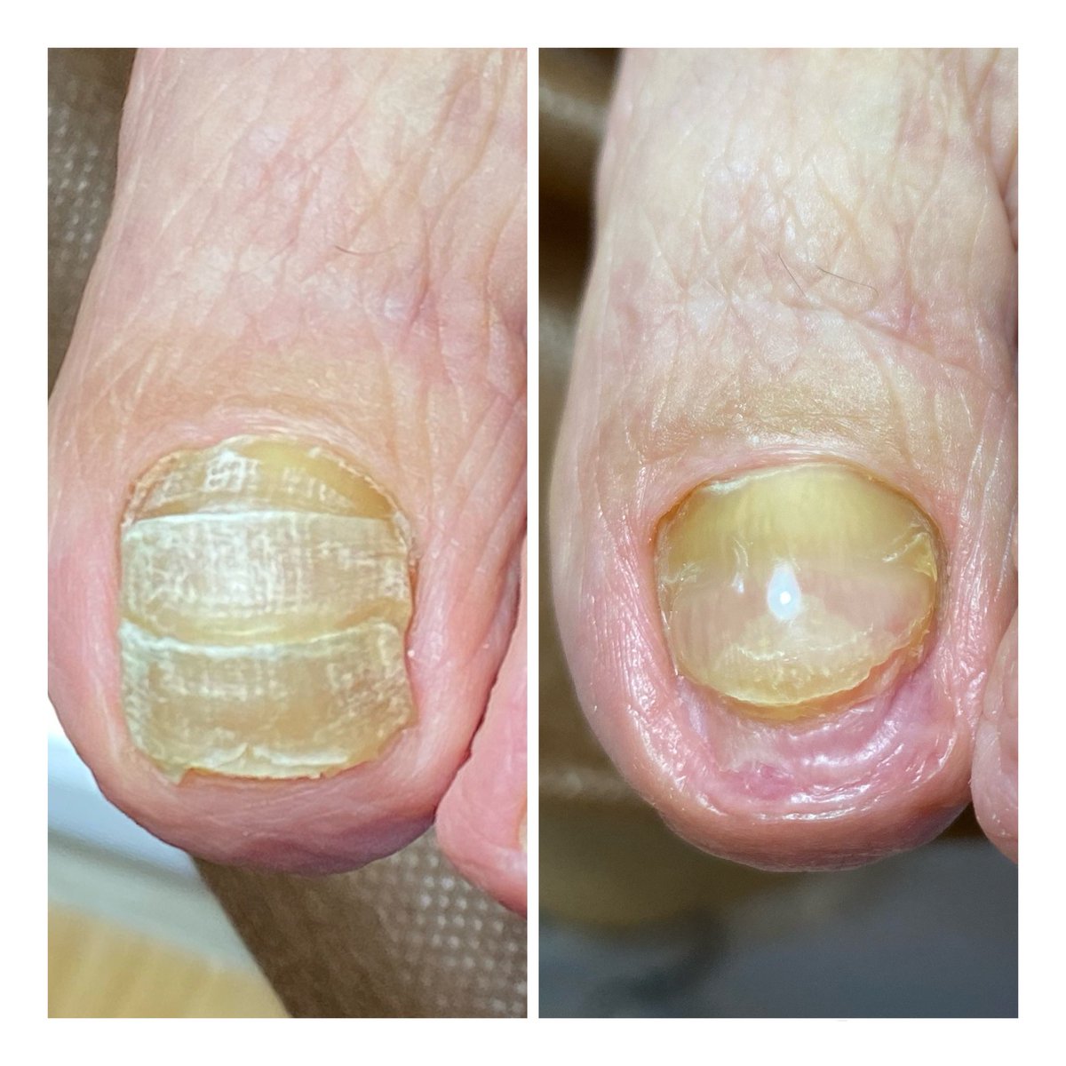 nailmelange's tweet photo. フットケアは
指先を綺麗にするのみではなく
色々なトラブルネイルもお手入れしたりしています☺️ https://t.co/HljNCUhq0c