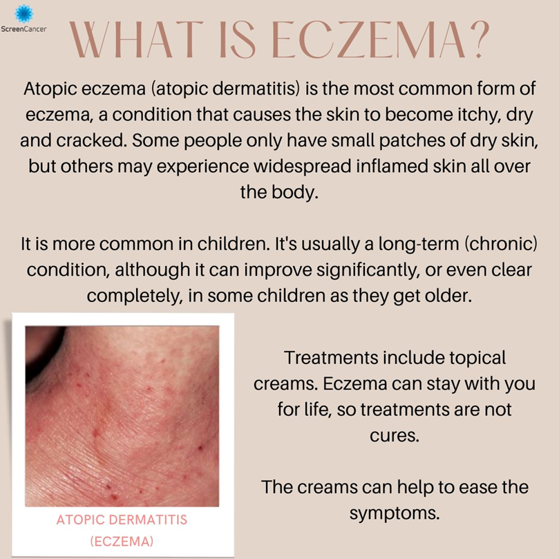 ScreenCancer_UK's tweet image. What is #Eczema? You may have heard of it, but do you know what it is?🤔
#SkinCondition #SkinScanning #SkinCare