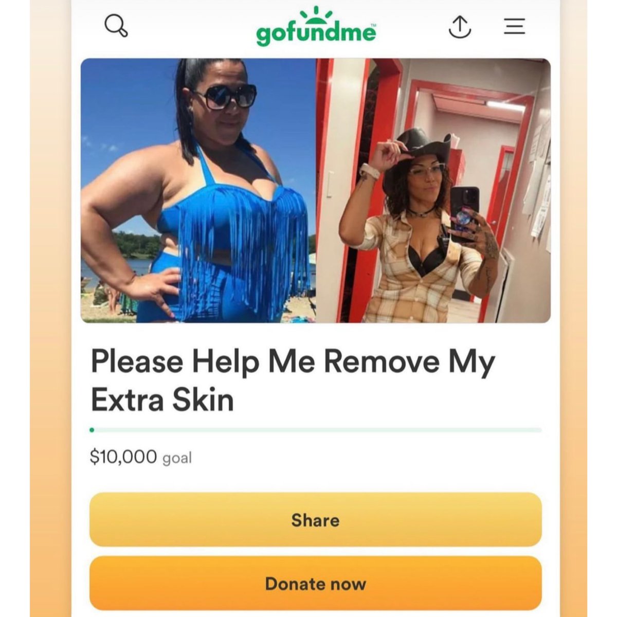 Link in my bio, read my story and help me out please & thank you🥰🩷 #models#bariatricjourney#weightloss#fyp#help#skinremovalsurgery#gofundme