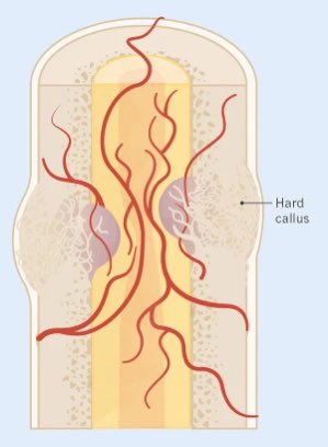 Omid_HopeUni's tweet photo. Bone fracture healing process👇🏼

> Fracture
> Haematoma (0-2 weeks)
> Callus formation (2-6 weeks)
> Hard callus formation (6-12 weeks) 
> Continued remodeling (months/years)

#bone #fracture #healing 
Credit: Lucy Reading-Ikkanda 
https://t.co/lj3xoHMaCs https://t.co/HzCbMJTo6I