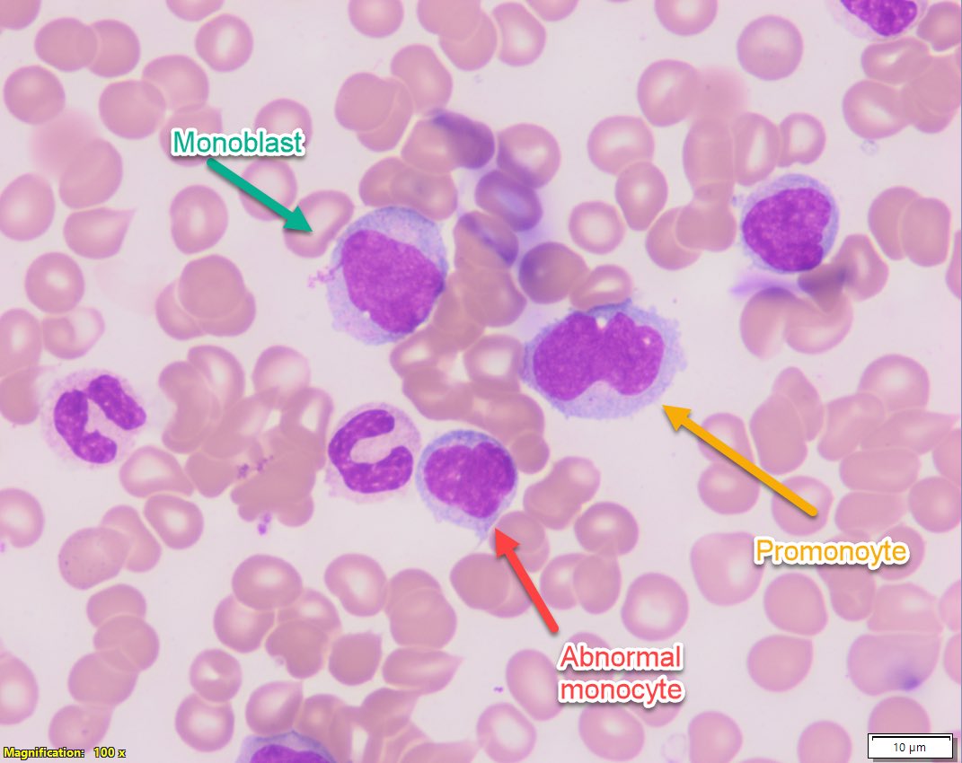 #hemepath guide 4 counting monocytes &amp; blasts in monocytic AML! Hard diffs.. even w/ experienc.
Monoblasts &amp; promonocytes R blast equivalents
Common monocytic genetics: KMT2A-r; Inv(16), RAS pathway mutations, NUP98-r, NPM1
Increased freq of venetoclax resistance
#leusm