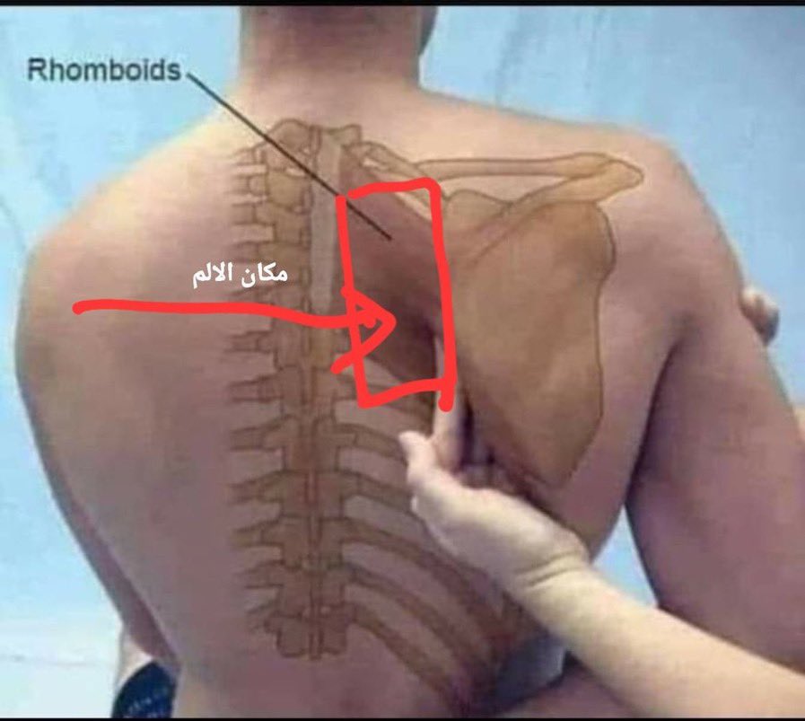 Abdulraman9's tweet photo. 🛑الابهر الوثاب❗️
الم ما بين الكتفين والابهر عباره عن ألتواء او شد بين لوحي عضلات الكتف.
من اسبابه
-التعرض للبرد أثناء الاستحمام بين لوح الكتف او أثناء التعرق والتعرض لهواء بارد
- وجود عقده عضليه ناتج عن التهاب سابق في نفس المكان
-النوم بوضعيات خطأ واغلبها النوم على البطن
تابع2 https://t.co/bgLvoV8ZzI