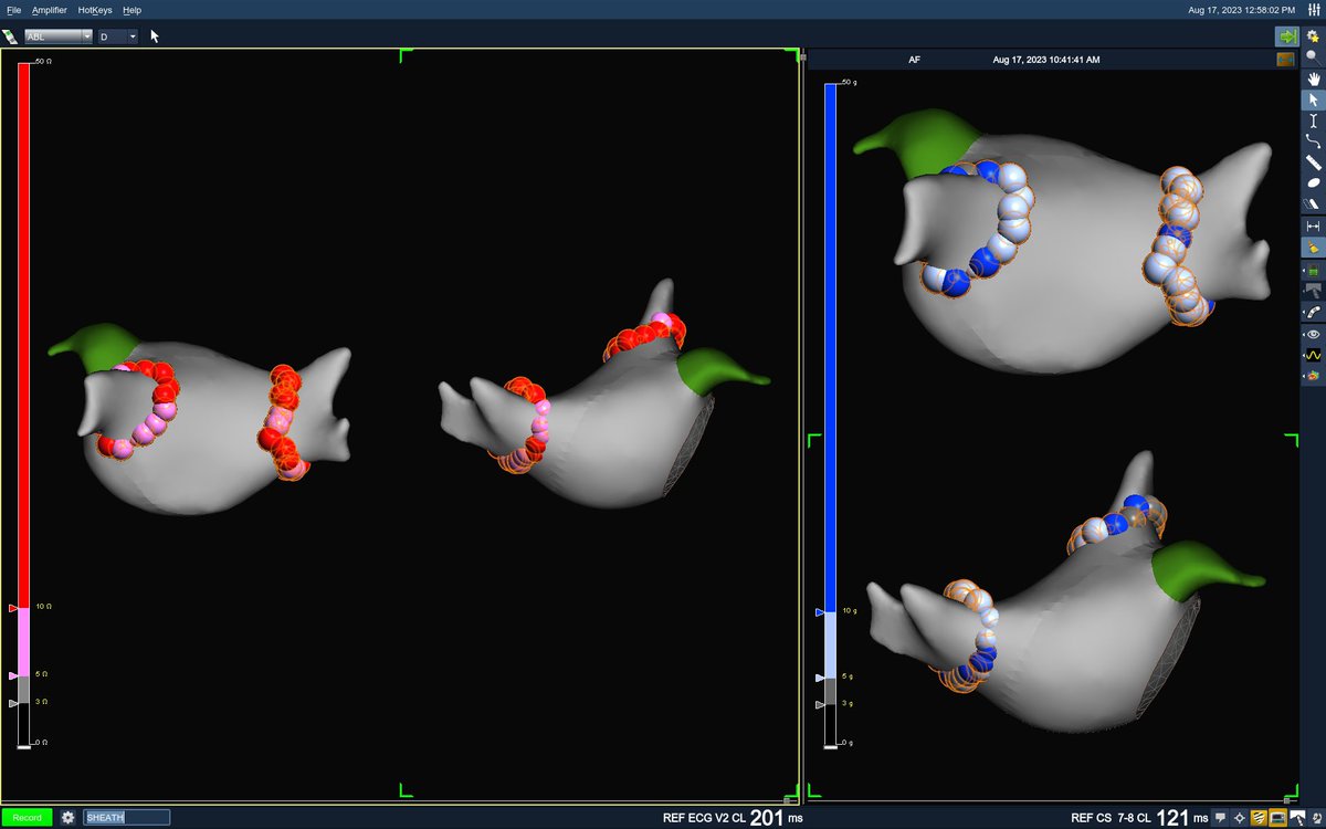 jordinarymaps's tweet photo. Left common pulmonary vein, a desirable anatomy for RF?

https://t.co/rSZWIcMeiu

@JCardioEP  @Ashit_EPS @forkknifecab_EP https://t.co/xonZlm3mIv