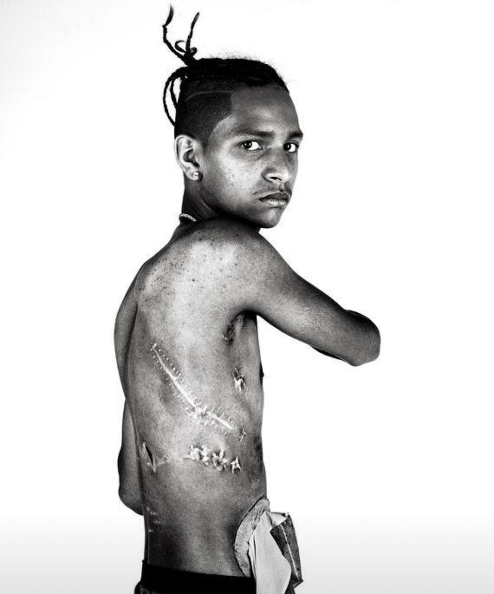 Anthony Borges, the then 15-year-old boy who used his body to shield his classmates during the Parkland School Shooting, shows his scars. He was shot 5 times.
