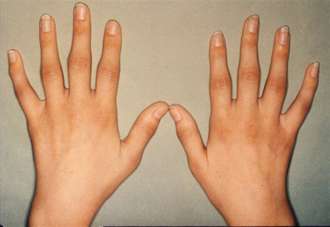 RheumCalc's tweet photo. We’ve updated the design of our DAS28 calculator to make assessing #diseaseActivity in #RheumatoidArthritis easier

https://t.co/iGtx6nUJRj

#MedTwitter #RheumTwitter https://t.co/76mm8DapZr