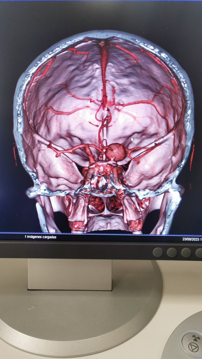 #Angiotc cerebro en pacientes con cefalea.. Hallazgo de aneurisma en carótida derecha. #valdiviacl #FelizMiercoles #TheLulosShows
