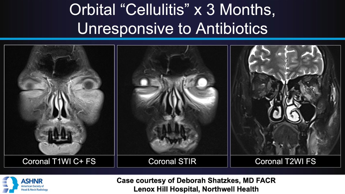 #ASHNRCOTW #225: Orbital 'cellulitis' x3 mo, unresponsive to abx. Dx? Thx Dr. @DShatzkes 4 case! #ASHNR23 Answer w/ appropriate GIF only -- stay professional & don't spoil it! @AshokSrini15 @callyrobs @CDP_Rad @rhwiggins @nakoontz @cmtomblinson @ESHNRSociety @tabby_kennedy