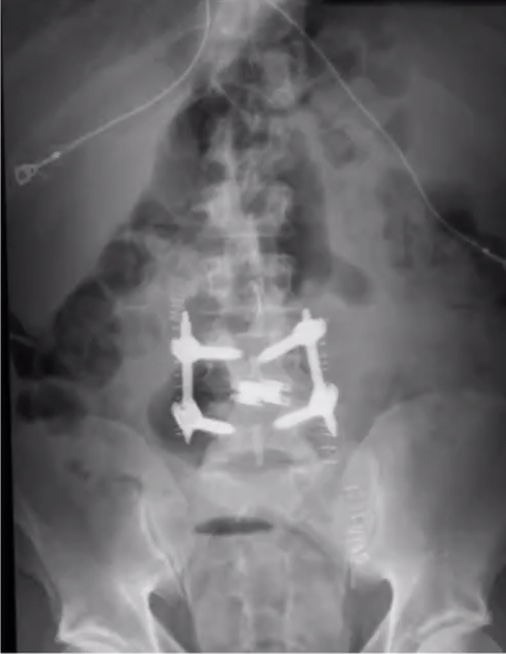 abdelbarrspine's tweet photo. @DukeSpine MIS Case Conference.Dr. @Amwab presented on 2 cases: 1) Biportal lumbar endoscopic decompression and 2) Mixed-Reality, Patient-Specific TLIF.   I learn as much as I teach in these conferences. https://t.co/WrJtA9Zcxg