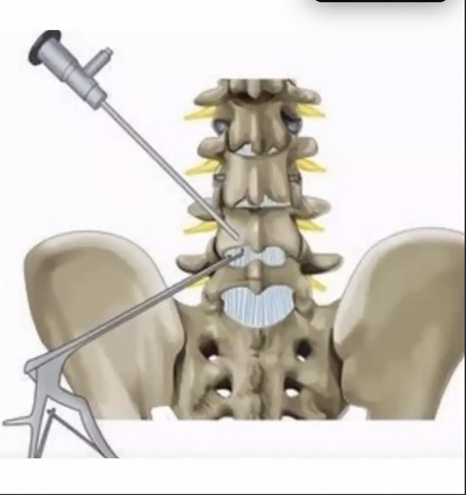 abdelbarrspine's tweet photo. @DukeSpine MIS Case Conference.Dr. @Amwab presented on 2 cases: 1) Biportal lumbar endoscopic decompression and 2) Mixed-Reality, Patient-Specific TLIF.   I learn as much as I teach in these conferences. https://t.co/WrJtA9Zcxg