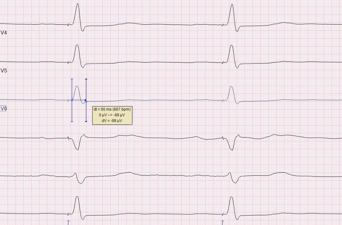#EPeeps #dontdisthehis #LBBpacing #conductionsystempacing

97 yo man 😳