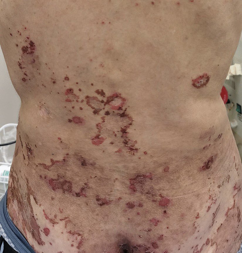 Patient presents with weight loss, new onset diabetes and a rash. What’s the diagnosis?