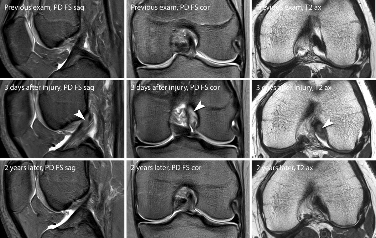 EssentialsMri's tweet photo. Partial tears ACL tears: always difficult. Often we do not know if the diagnosis was correct (conservative therapy). In this case, comparison with an older and later exam demonstrates the injury at the origin of the posterolateral bundle. #mskrad #orthotwitter #radres #radiology https://t.co/HSYuBlVUBx