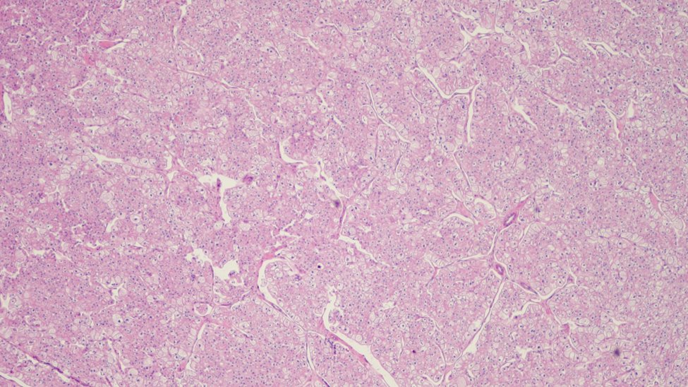 MhPathology's tweet image. 40-year-old man with left renal mass
Chromophobe renal cell carcinoma #Medpath #MedTwitter 
Case by @Vinesh_jhambia