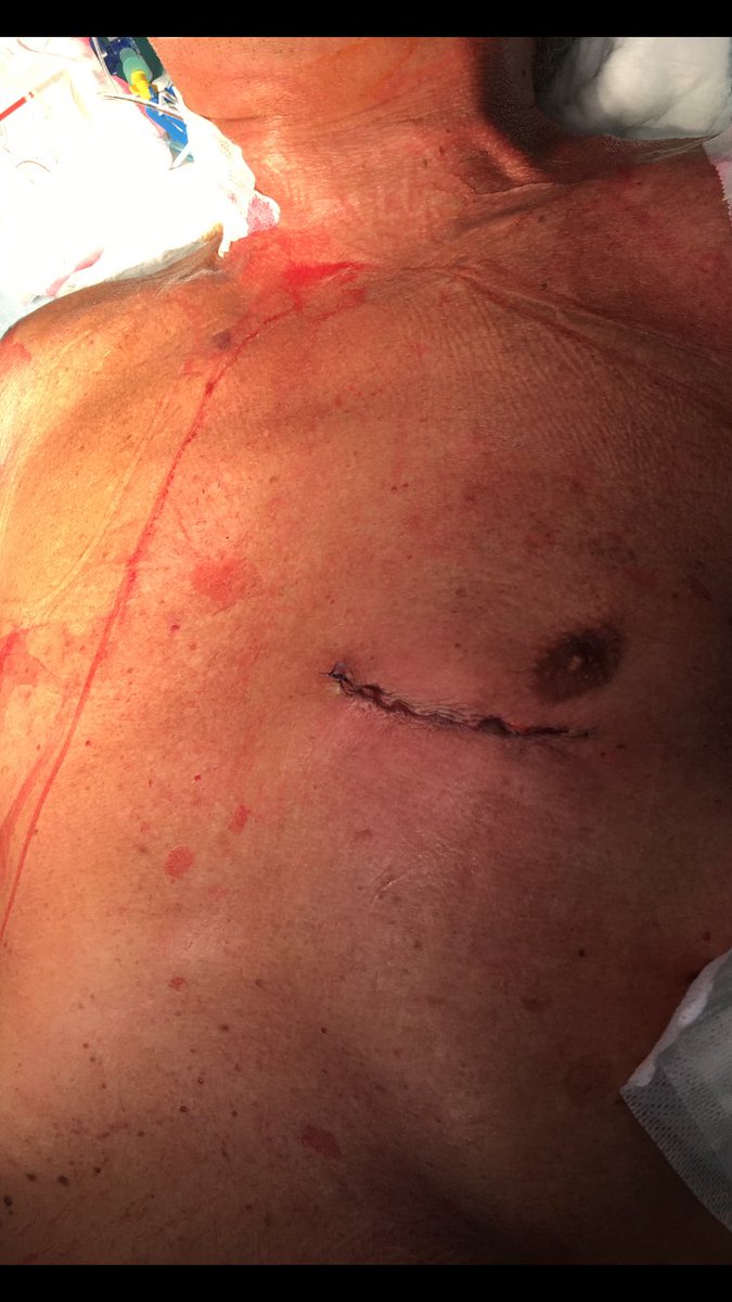 GConcistre's tweet photo. Minimally invasive CABG: the present and the future of myocardial revascularitation
#cardiacsurgery #minimallyinvasive #myocardialrevascularitation #cabg #midcab #myocardialinfarction
@marcosolinas12 @opa_massa https://t.co/K3wM7nsD8C