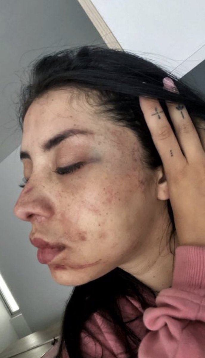 karol_maye's tweet photo. #StanALaCarcel 🚨Por favor replicar esta información: el señor Esteban Hoyos conocido como BigStan casi mata a mi amiga, el tipo está libre y la @FiscaliaCol no ha mostrado celeridad en el proceso. No sé si están esperando que esté sujeto la mate para hacer justicia. https://t.co/gRB84UmtDW