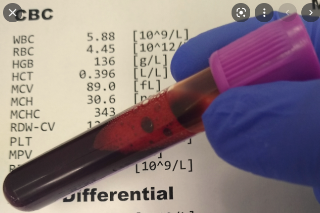 mls2030's tweet photo. Your career decision:  Do you want to be a nurse and work directly with a few patients OR would you prefer to work behind the scenes to provide diagnostic test results for many patients.

This podcast compares nursing and medical laboratory scientists.
https://t.co/wQvfBgjegO https://t.co/l7h86Bc2f3