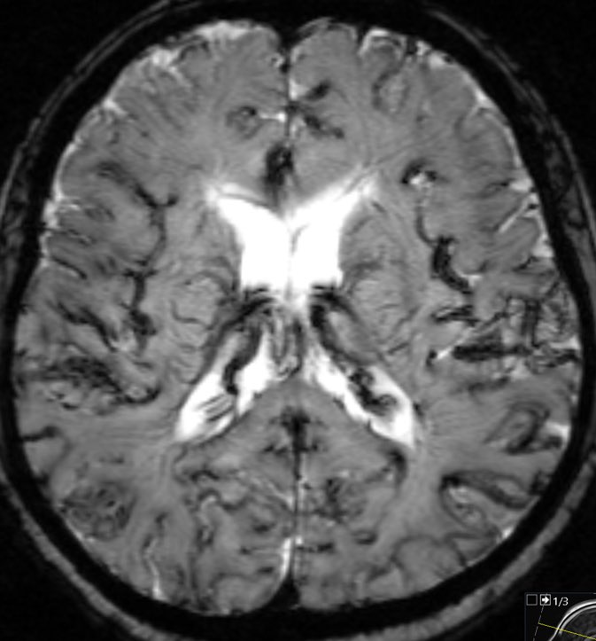 daniel_gewolb's tweet photo. What is the most likely diagnosis in this outpatient w/ history of chronic kidney disease and lung cancer scanned to evaluate for metastatic disease? 

#Neurology #neurosurgery #radres #futureradres #MedEd @RSNA https://t.co/GhtBPMLyF1