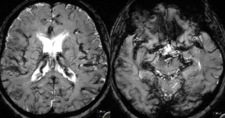 daniel_gewolb's tweet photo. What is the most likely diagnosis in this outpatient w/ history of chronic kidney disease and lung cancer scanned to evaluate for metastatic disease? 

#Neurology #neurosurgery #radres #futureradres #MedEd @RSNA https://t.co/GhtBPMLyF1