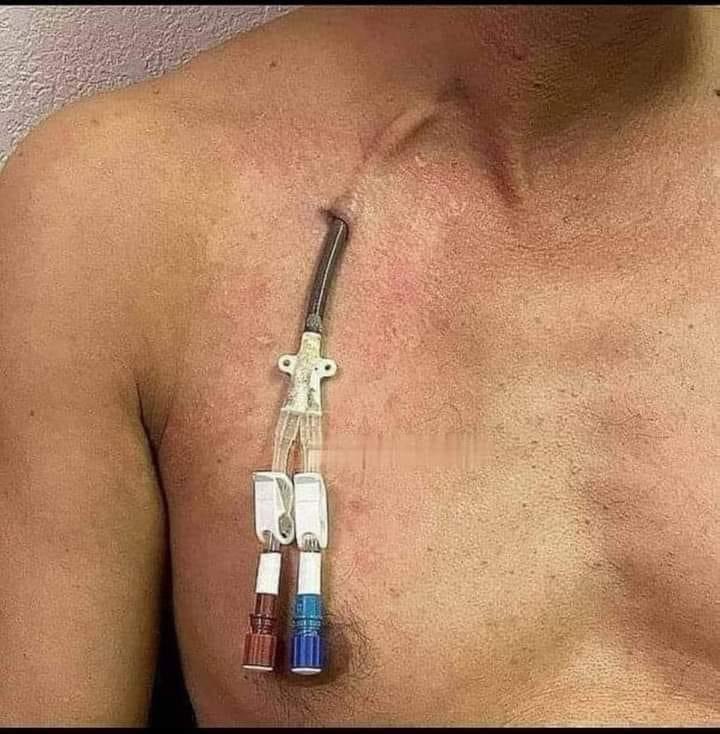 ڈائلاسس(Dialysis) کے دوران جسم سے خون سرخ نالی سے باہر نکالا جاتا ہے ، پھر مشین سے اسے گزارنے کے بعد جسم میں دوبارہ نیلی نلی سے داخل کردیا جاتا ہے۔  

ایک ڈائلاسیس کا process تقریباً چار گھنٹے چلتا ہے، اور یہ عمل مریض کو ہفتے میں دو سے تین مرتبہ دہرانا پڑتا۔ 

وہیں جن لوگوں کے