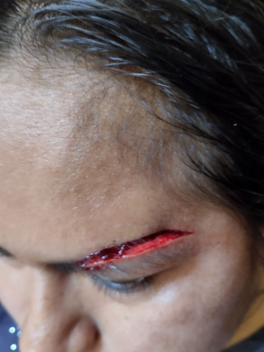 janethinostroza's tweet photo. El Prefecto de Morona Santiago Tiyua Uyuncar, golpeó brutalmente a su esposa, es un acto imperdonable, inaceptable y brutal. Me encantaría contarles que la Viceprefecta Daniela Veintimilla, en un acto de justicia y solidaridad, acompañó a la madre de la agredida a denunciar al agresor, pero no, no se puso de lado de la víctima, acorde a la versión de la madre,  le ofreció dinero para silenciarla. #indignate
