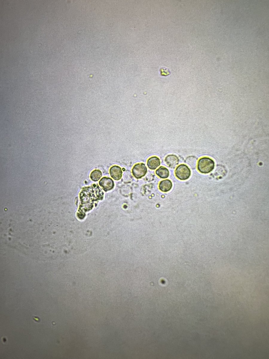 msc271's tweet photo. 28YO Hispanic man with no sig PMH who presented c/o fever, joint pain and rash and admitted for further workup. #UrineMicroscopy #UrineSediment #RBCCast https://t.co/pjxXaaAc9d