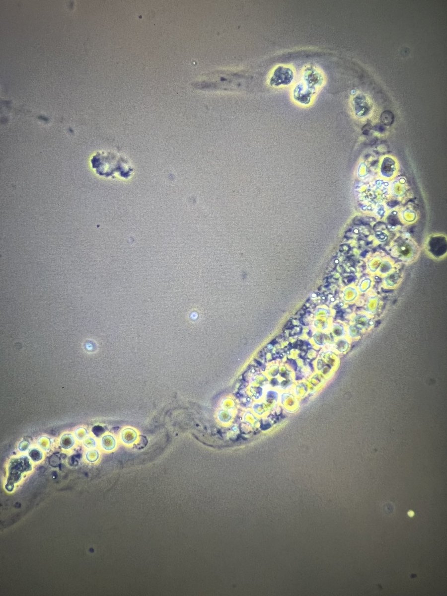 msc271's tweet photo. 28YO Hispanic man with no sig PMH who presented c/o fever, joint pain and rash and admitted for further workup. #UrineMicroscopy #UrineSediment #RBCCast https://t.co/pjxXaaAc9d