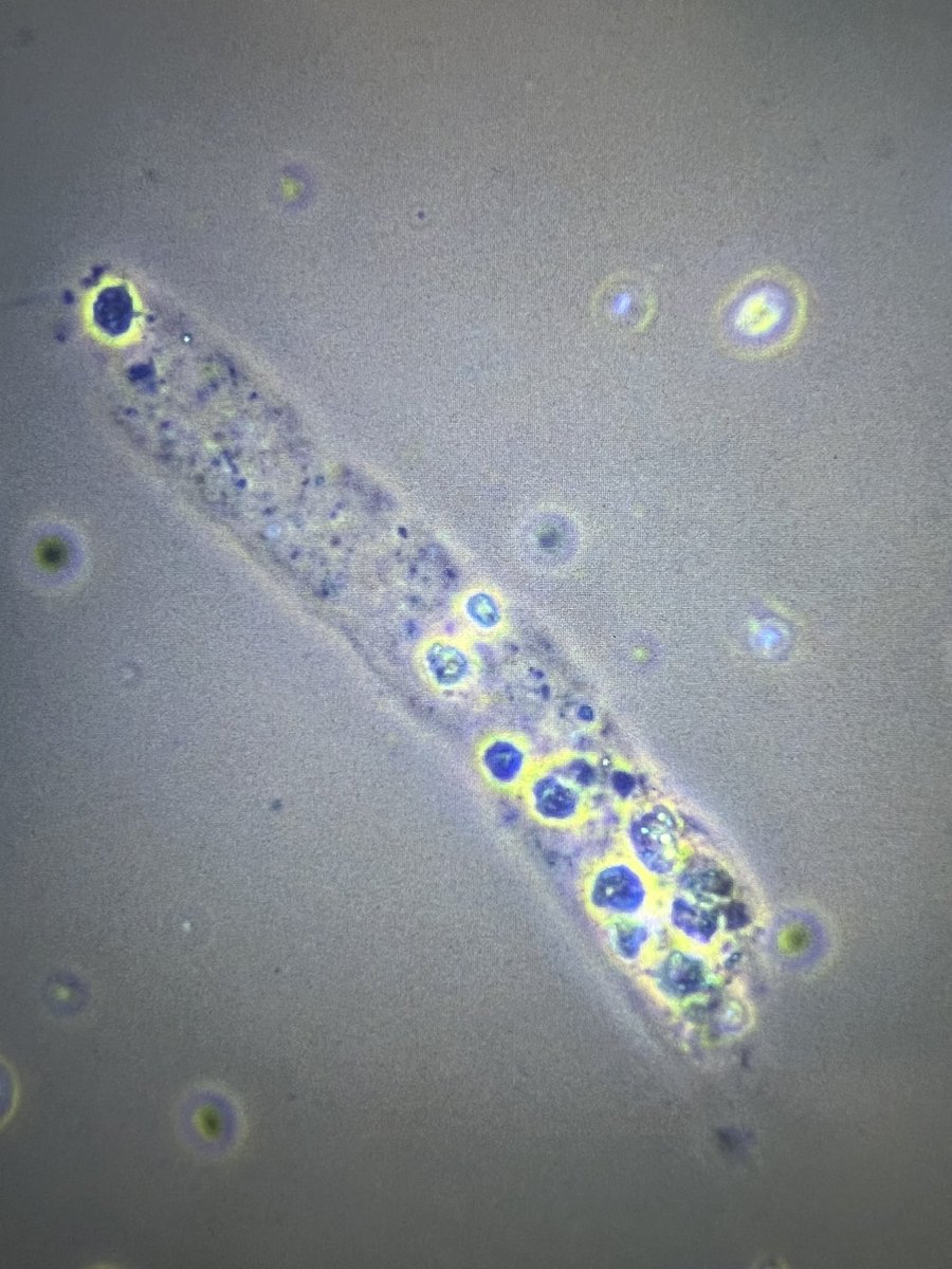 msc271's tweet photo. 28YO Hispanic man with no sig PMH who presented c/o fever, joint pain and rash and admitted for further workup. #UrineMicroscopy #UrineSediment #RBCCast https://t.co/pjxXaaAc9d